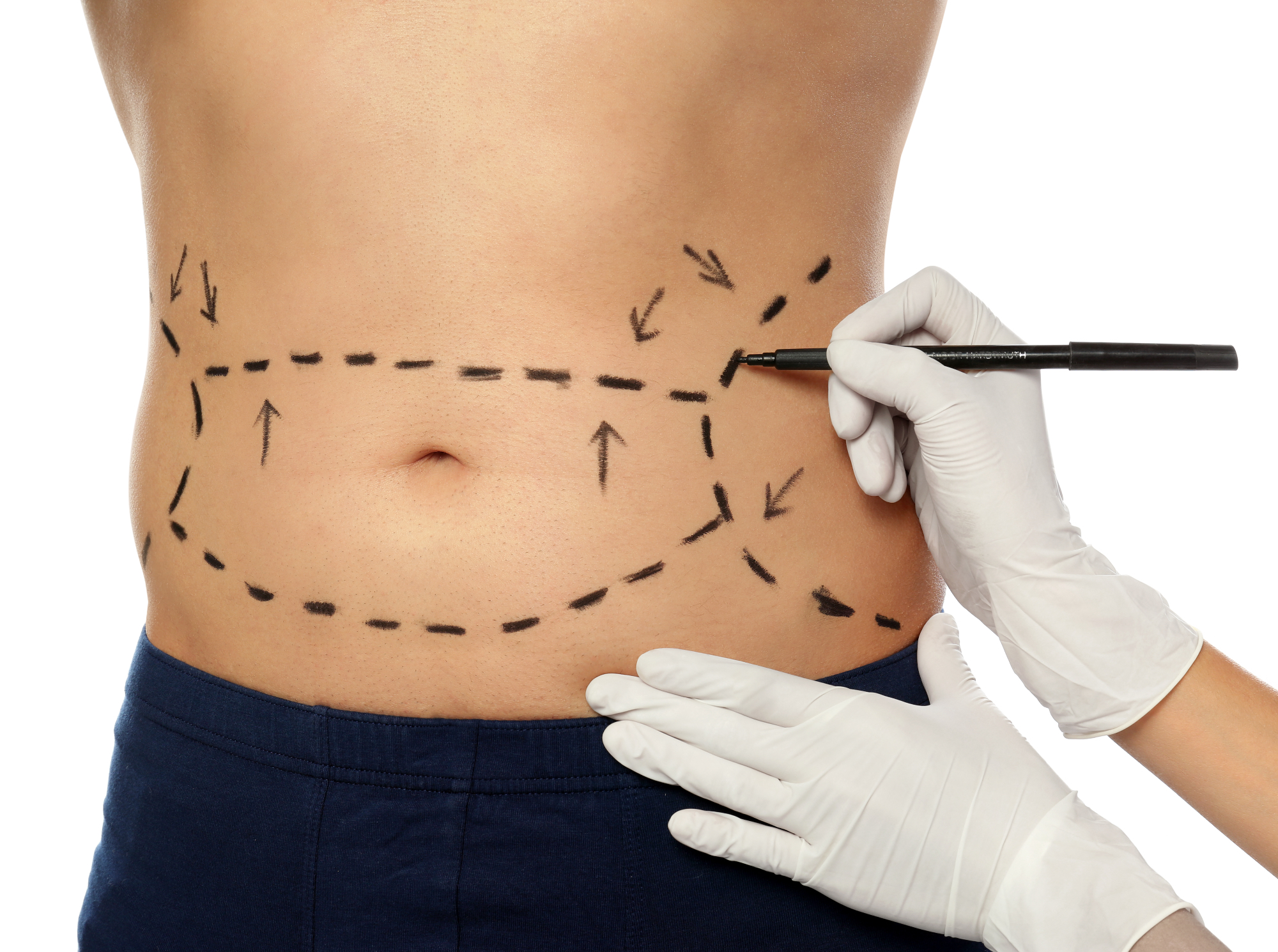 Silhouette snella con liposuzione